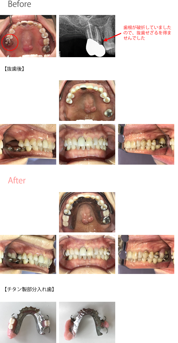 チタン製義歯