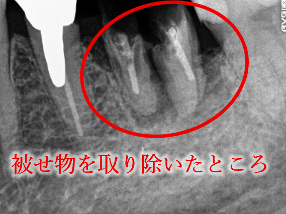 インプラント
