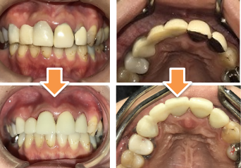 同時進行で色んな歯の治療と、１つずつの治療、どちらが正解？